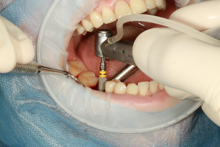 Implantes dentales